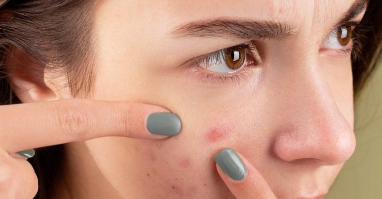 Acne Treatments - Woman Squeezing Her Pimples with Her Fingers